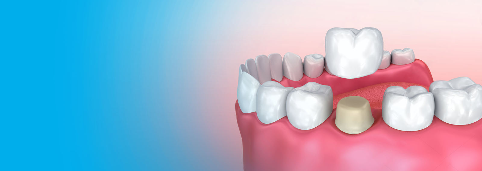 Crowns Bridges Treatment in Dahisar
