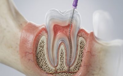 Root Canal Treatment: Myths vs. Reality