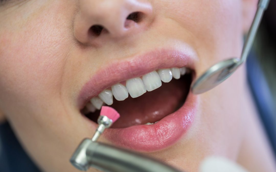 Teeth Whitening: Professional Treatment vs. Home Remedies