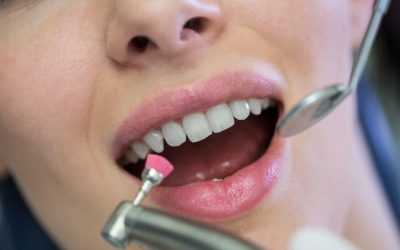 Teeth Whitening: Professional Treatment vs. Home Remedies