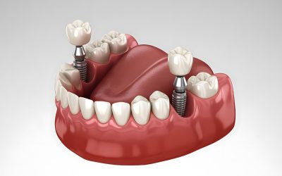 Dental Implants: Everything You Need to Know